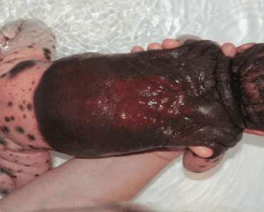 Mom Was Shocked To See Her Newborn Covered In Dark, Bloody Spots