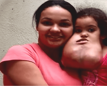 3-Year-Old Suffered From Continually Growing Facial Tumor, Her Transformation After Surgery Is Incredible…