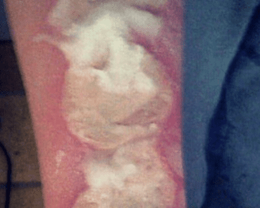 Trending ‘Salt And Ice Burn Challenge’ Is Just As Painfully Unsafe As It Is Stupid