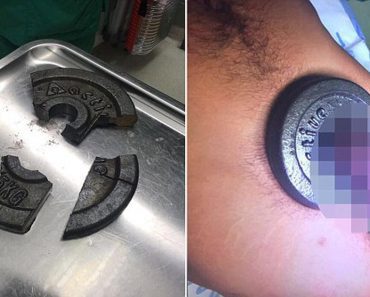 Bodybuilder’s Genitalia Sawed Out Of Weightlifting Plate After Getting Trapped In Heavy Metal Disc