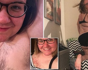 Woman With Excessive Body Hair Decides To Embrace Her Natural Look