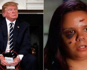 Teen Shot In Both Legs With Shrapnel Behind Her Eye Dismisses Trump