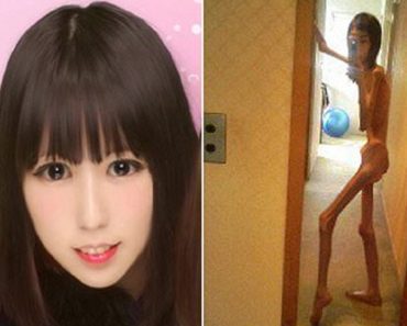 Japanese Woman Shares Shocking Selfies From When She Weighed 37lbs